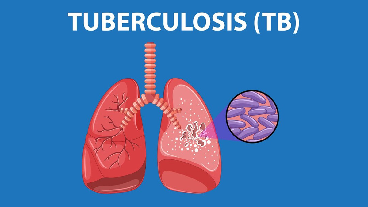 India Tops Global Tuberculosis Cases: Urgent Innovations Needed to Curb the Epidemic